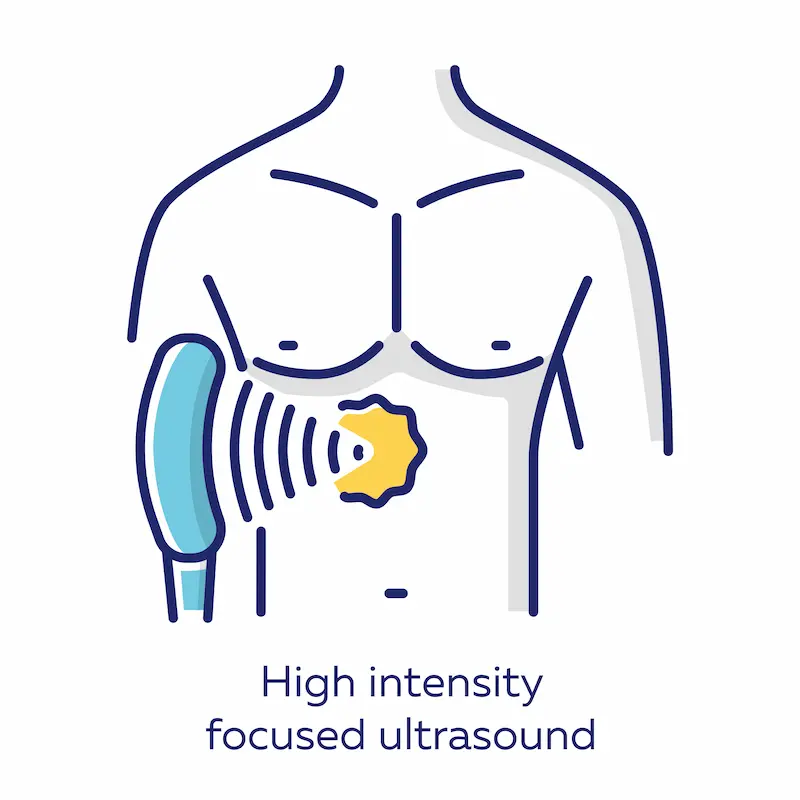 High-Intensity Focused Ultrasound (HIFU)