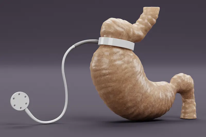 Adjustable Gastric Band Turkey