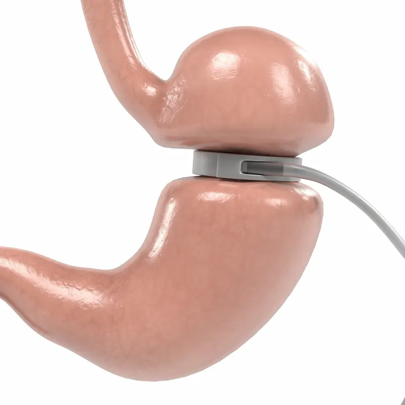 Бандажирование желудка в Турции: 3D-иллюстрация, показывающая, как бандаж устанавливается на верхнюю часть желудка.