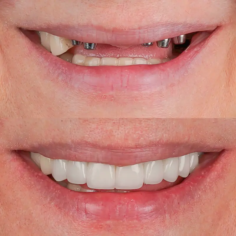 Dental Implant Before and After