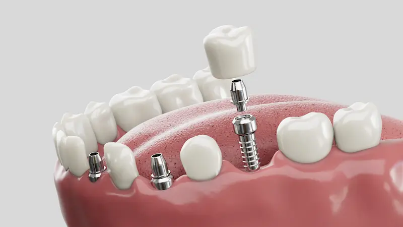 Dental Implants in Turkey