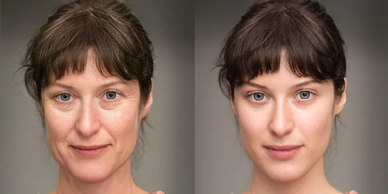 Face Lift Before and After