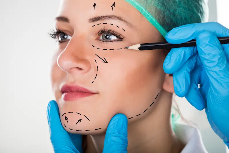 Facelift Rhytidectomy