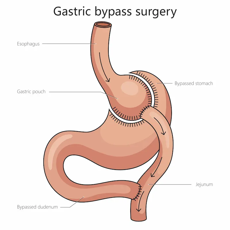 Gastric Bypass in Turkey