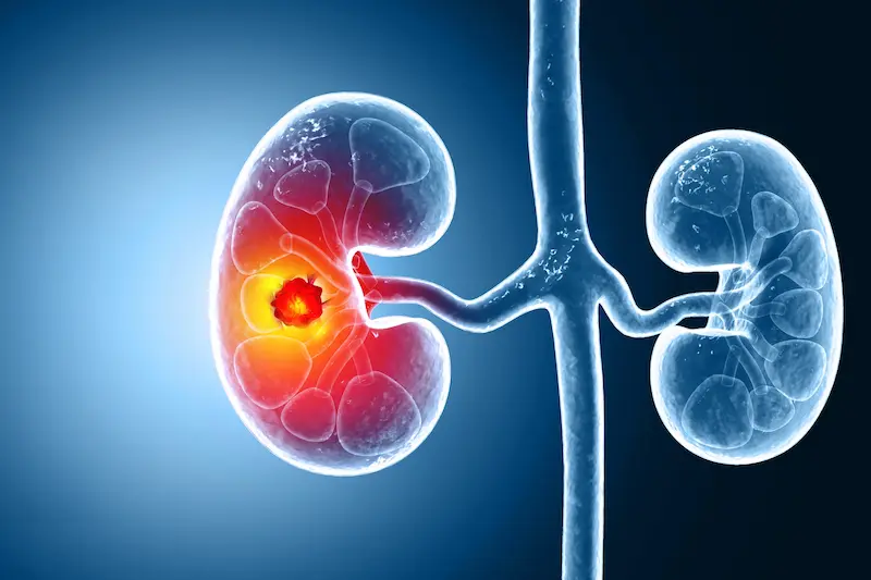 Kidney Tumors Treatment in Turkey