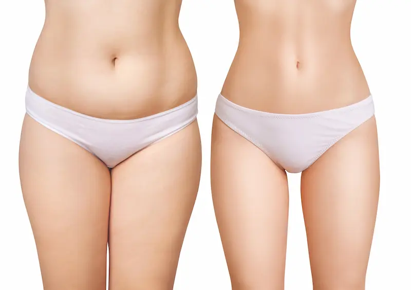Liposuction Before and After
