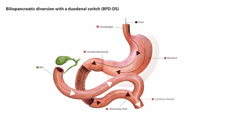 Операция SADI-S (дуоденальное шунтирование): инфографика, показывающая анатомические изменения и новый путь пищеварения.