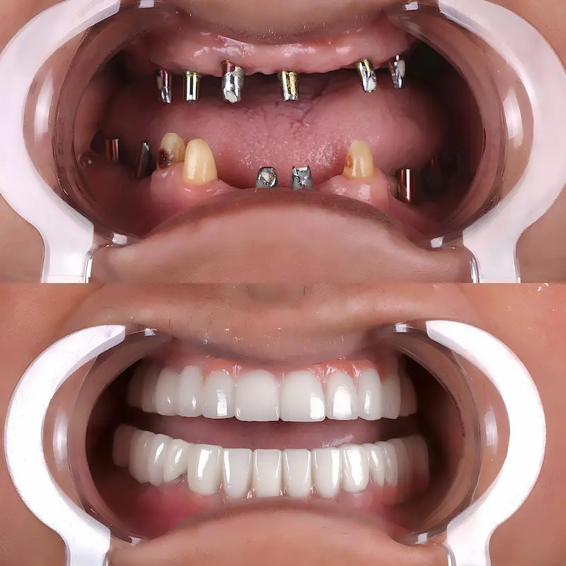 Teeth Implants Price in Turkey