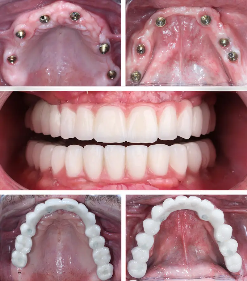 Цена на зубные импланты в Турции: фото до и после, показывающие установленные импланты и финальные протезы.