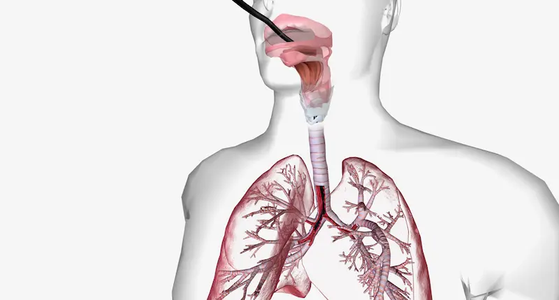 Bronchoscopy in Turkey