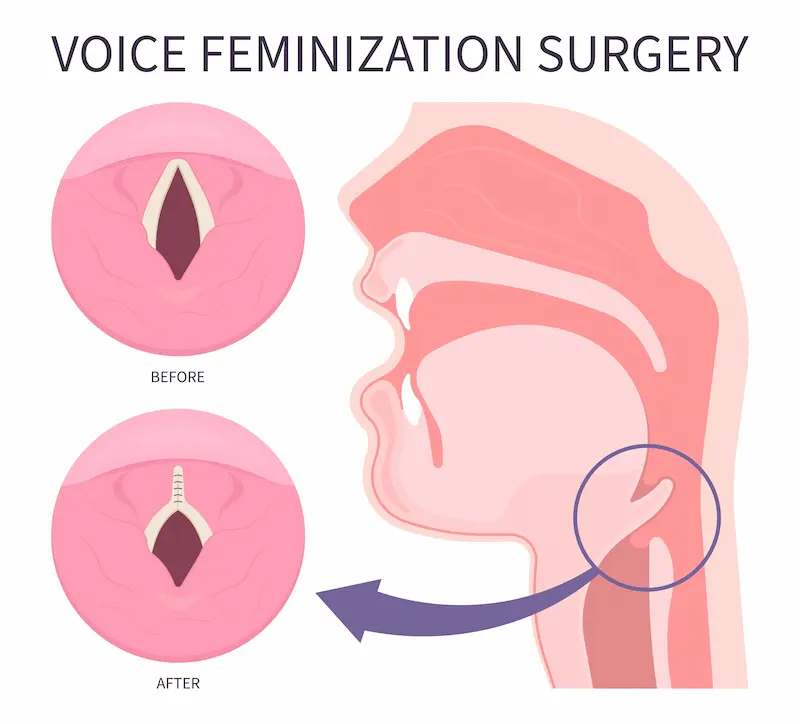 Voice Feminization: Before and After Surgery