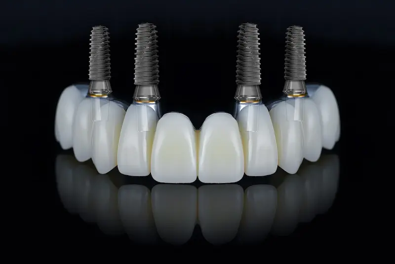 All On 4 Dental Implants Cost