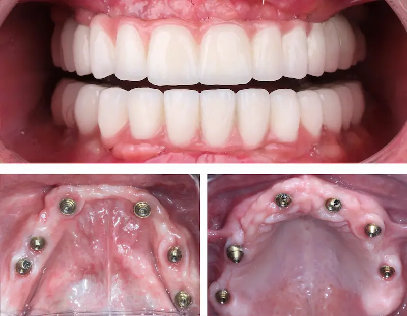 All On 6 Dental Implants Before and After