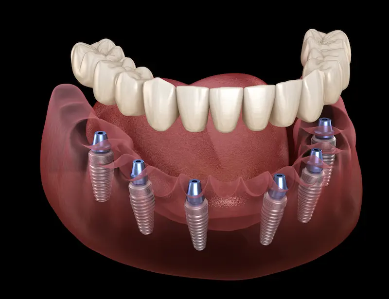 All On 6 Dental Implants Cost