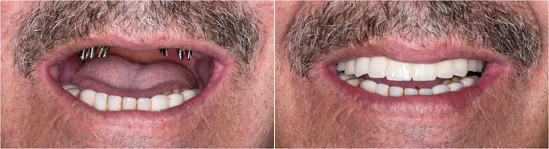 All On 6 Dental Implants Turkey