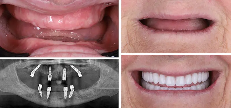 Before and After All On 4 Dental Implants