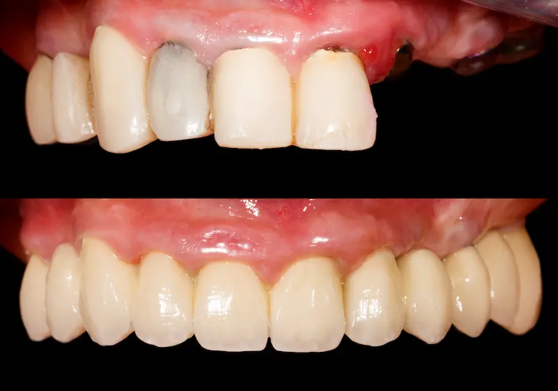 Before and After Dental Bridge