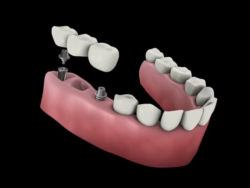 Dental Bridge Cost