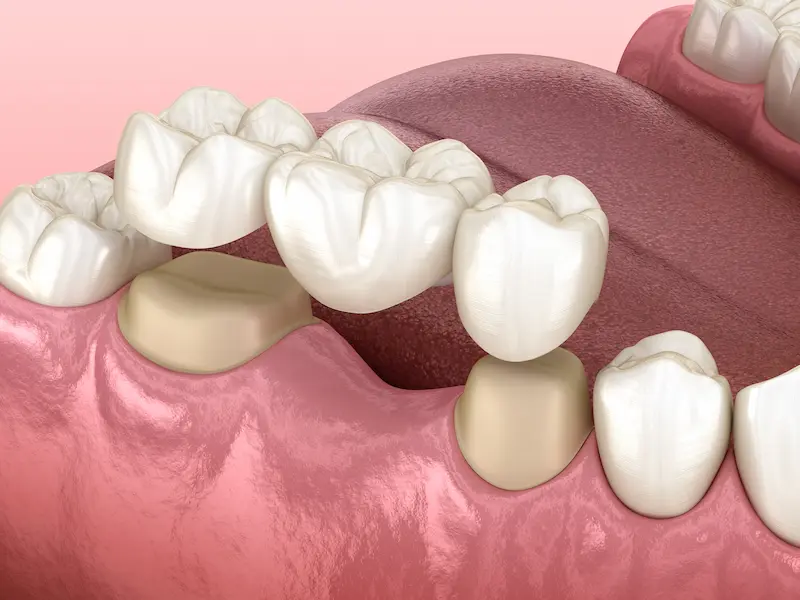 Консольный зубной мост: 3D-визуализация одностороннего протеза, установленного на соседних зубах.