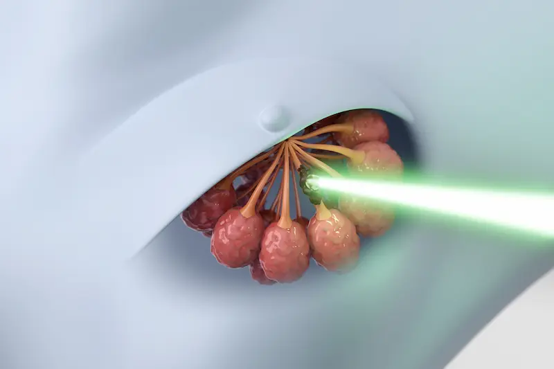 Лучевая терапия в Турции: концептуальная иллюстрация, где луч радиации направлен на раковые клетки.