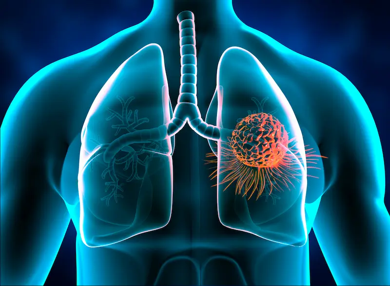 Lung Cancer Screening