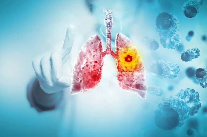 Lung Cancer Treatment Cost in Turkey