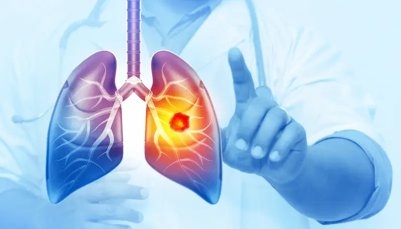Lung Cancer What are The Signs