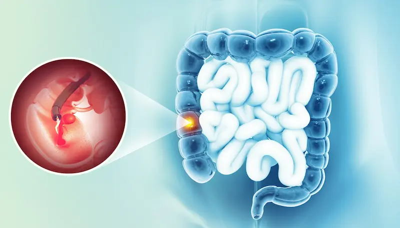 Подготовка к колоноскопии важна для успешной процедуры, такой как удаление полипа, показанное на иллюстрации.