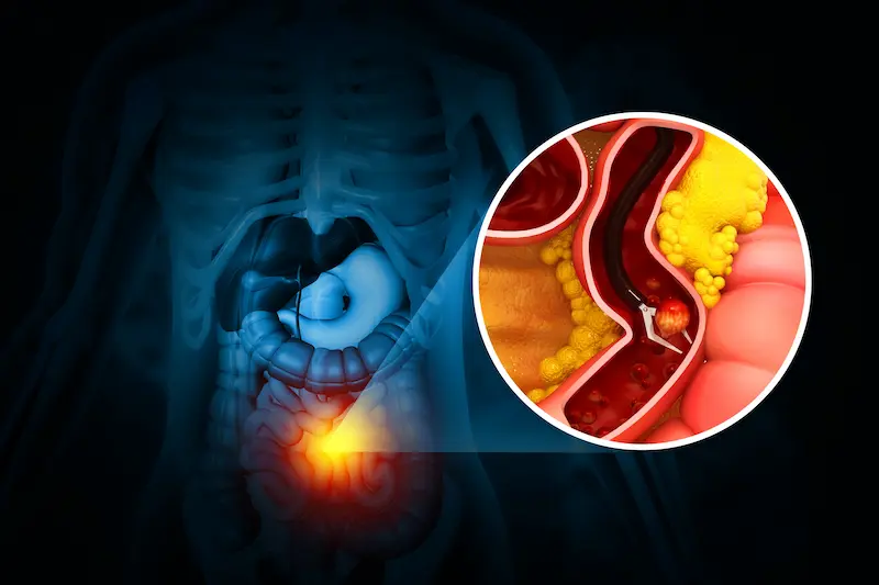 Стоимость колоноскопии: медицинская иллюстрация, показывающая колоноскоп внутри толстой кишки.