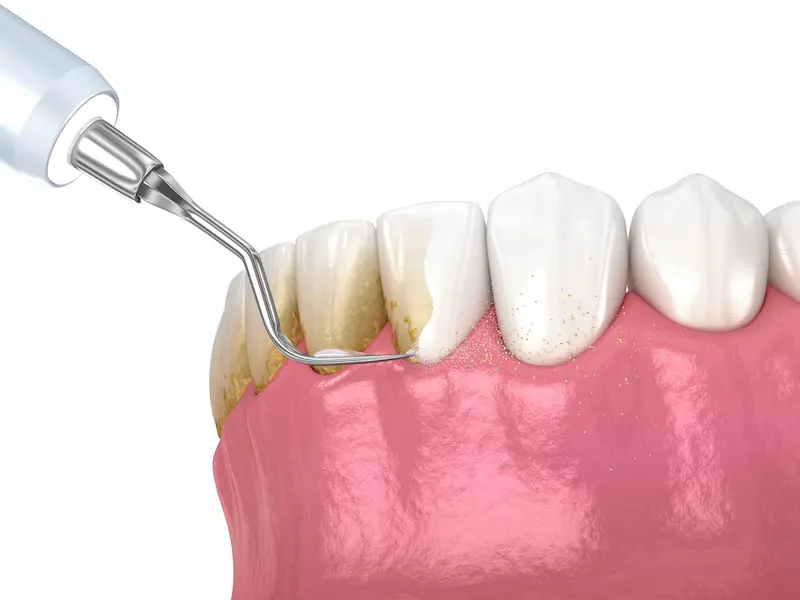 Teeth Cleaning and Scaling Procedures