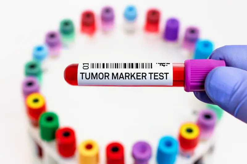 Thyroid Cancer Tumor Marker Blood Test