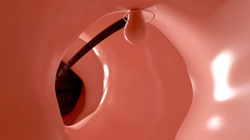 Удаление полипов во время колоноскопии: 3D-иллюстрация, показывающая, как эндоскопическая петля удаляет полип.