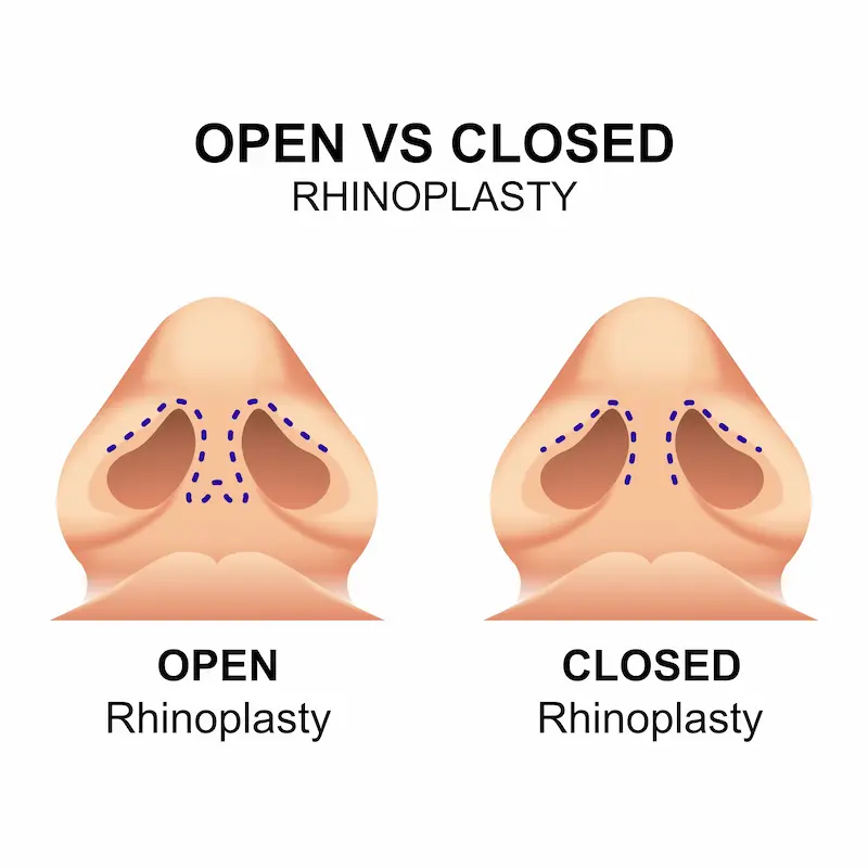 Open vs closed rhinoplasty