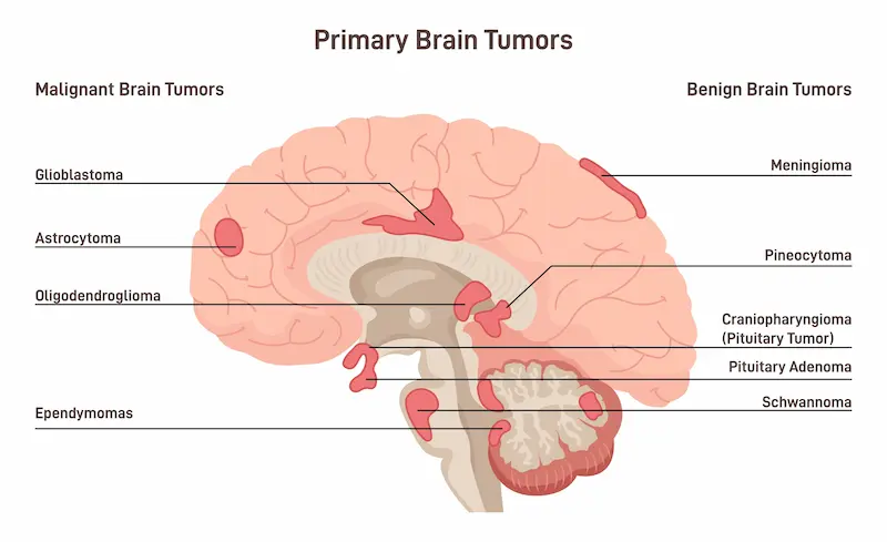 Primary brain tumors