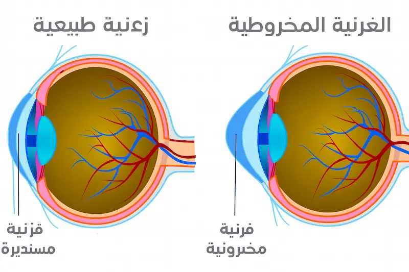 القرنية المخروطية