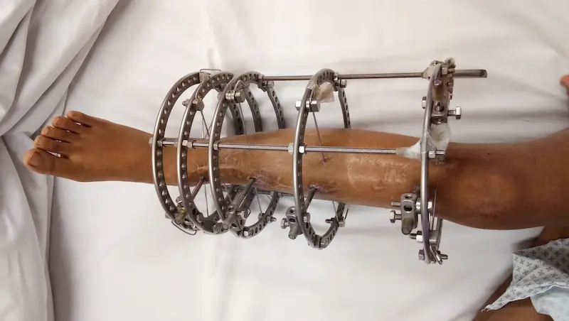 Аппарат Илизарова: нога пациента с установленным внешним компрессионно-дистракционным аппаратом.