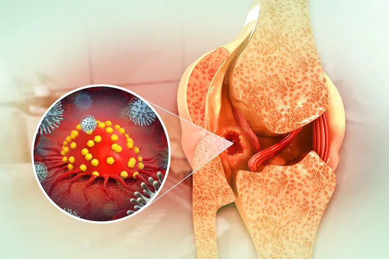 Доброкачественные ортопедические опухоли: 3D-иллюстрация опухоли кости в коленном суставе с увеличенным видом клеток.