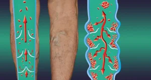 Эндоскопическая операция на венах в Турции: инфографика, сравнивающая здоровую вену и варикозную вену с нарушенным кровотоком.