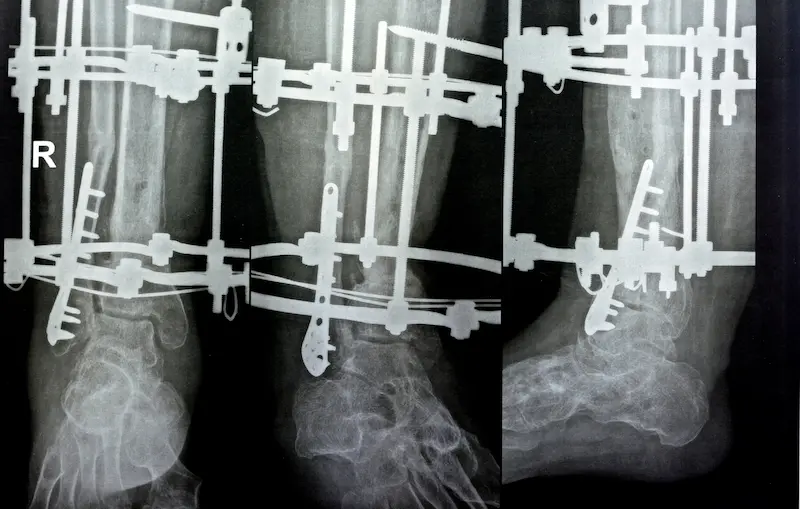 جراحة إطالة الأطراف-إليزاروف