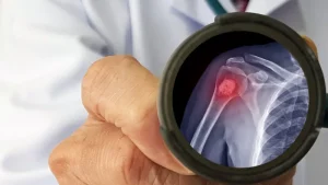 Онкоортопедия в Турции: Хирургия ортопедических опухолей в Турции: врач изучает рентгеновский снимок опухоли кости через увеличительное стекло.