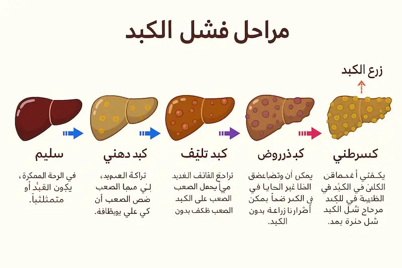 مراحل فشل الكبد