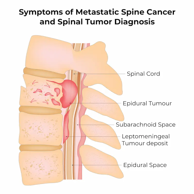 Симптомы и диагностика опухолей позвоночника: инфографика, показывающая расположение различных типов спинномозговых опухолей.