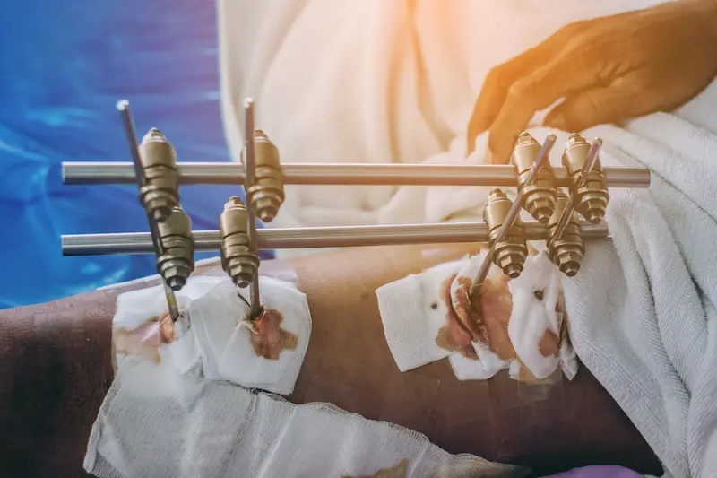 Стоимость лечения по методу Илизарова в Турции: крупный план внешнего фиксатора на ноге пациента после операции.