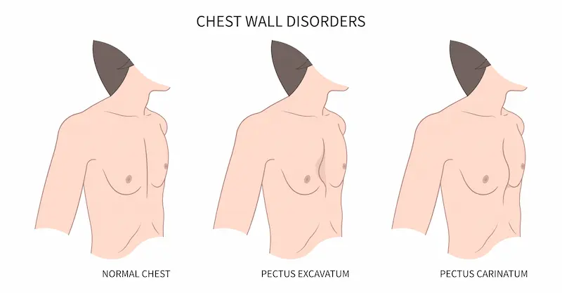 Chest Wall Disorders