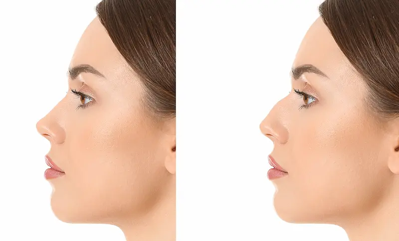 Rhinoplasty Before and After
