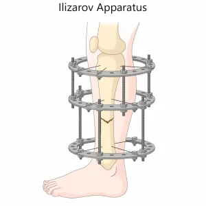 Операция по увеличению роста в Турции (Удлинению ног): иллюстрация, показывающая аппарат Илизарова, установленный на голени.