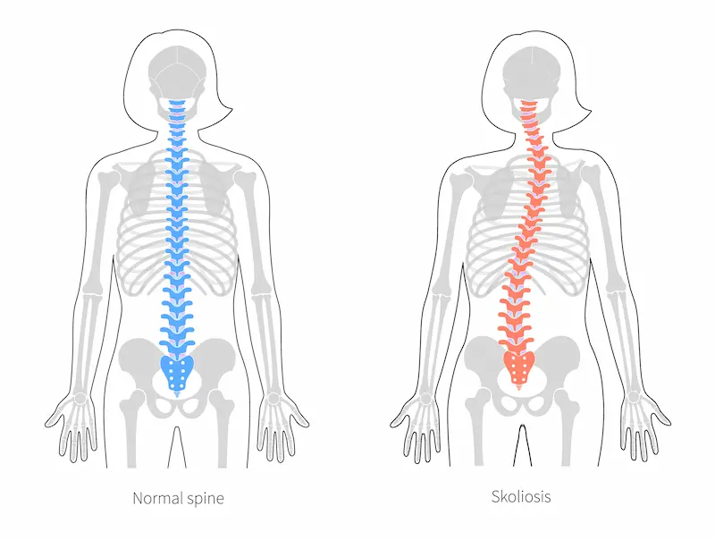 Сравнение нормального позвоночника и сколиоза: инфографика, показывающая прямой и искривленный позвоночник.