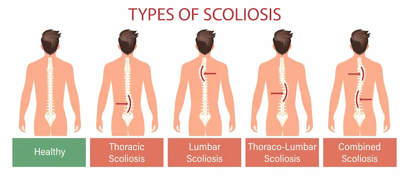 Типы сколиоза: инфографика, иллюстрирующая грудной, поясничный, грудопоясничный и комбинированный сколиоз.