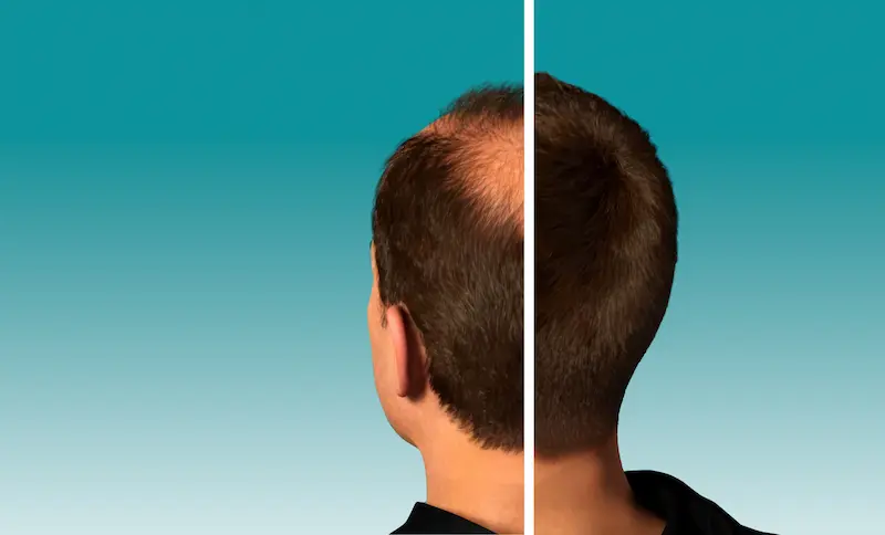 Hair Transplant in Turkey